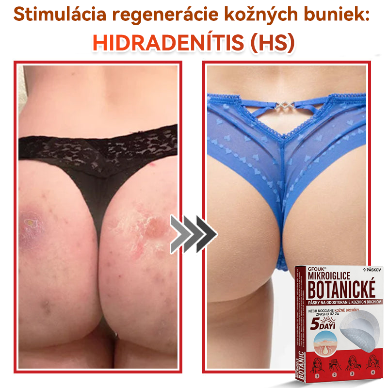 🗽✅GFOUK® MicroNeedle botanic náplasť na odstránenie kožných výrastkov Vyrobené