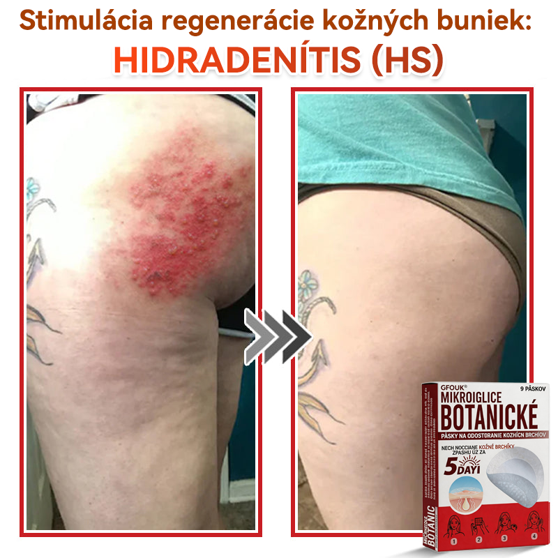 🗽✅GFOUK® MicroNeedle botanic náplasť na odstránenie kožných výrastkov Vyrobené