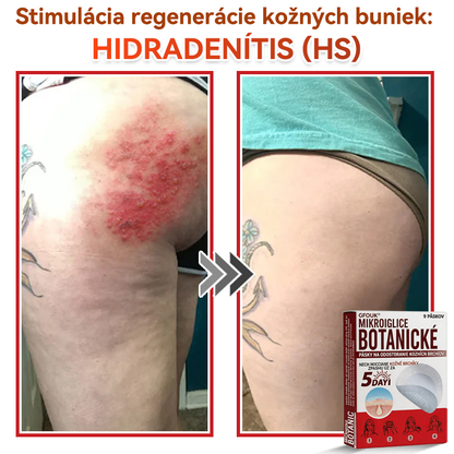 🗽✅GFOUK® MicroNeedle botanic náplasť na odstránenie kožných výrastkov Vyrobené
