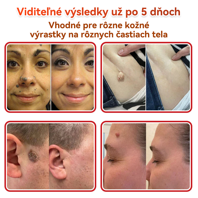 🗽✅GFOUK® MicroNeedle botanic náplasť na odstránenie kožných výrastkov Vyrobené