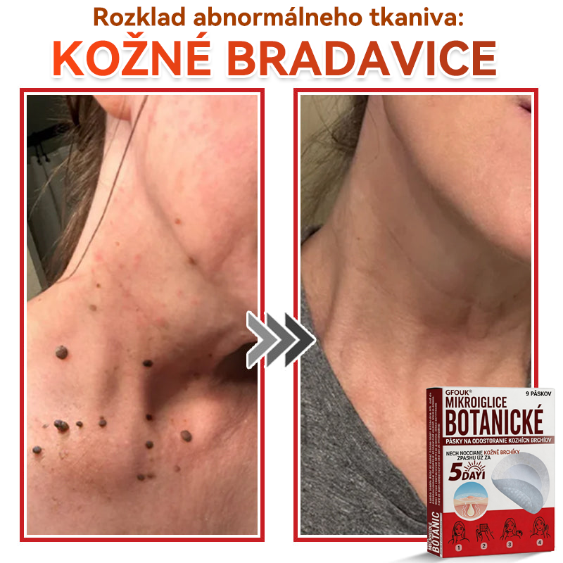 🗽✅GFOUK® MicroNeedle botanic náplasť na odstránenie kožných výrastkov Vyrobené