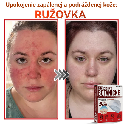 🗽✅GFOUK® MicroNeedle botanic náplasť na odstránenie kožných výrastkov Vyrobené