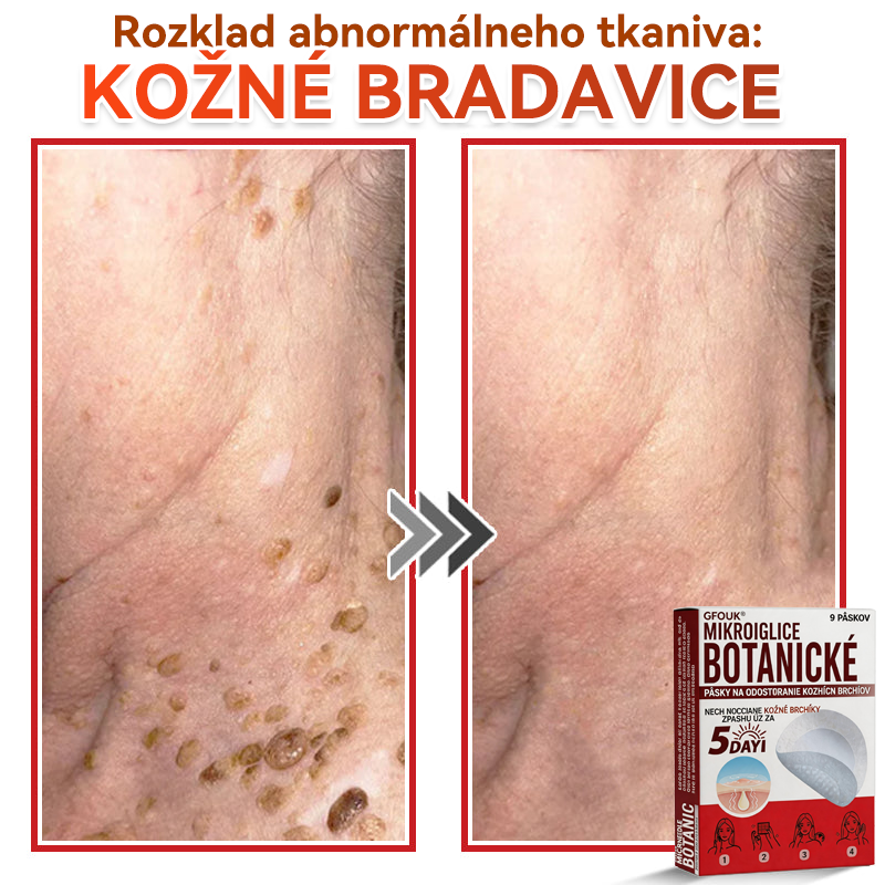 🗽✅GFOUK® MicroNeedle botanic náplasť na odstránenie kožných výrastkov Vyrobené