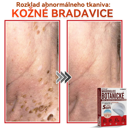 🗽✅GFOUK® MicroNeedle botanic náplasť na odstránenie kožných výrastkov Vyrobené
